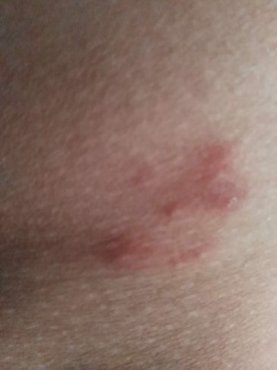 合胞病毒感染症状