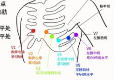 心电监护5个电极位置图