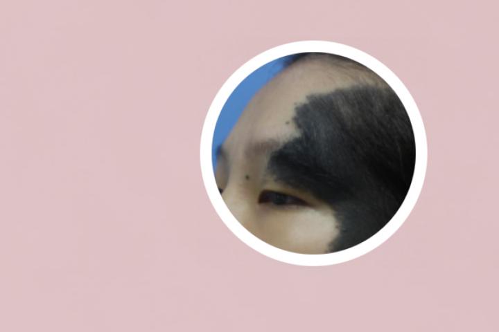 毛细血管瘤
