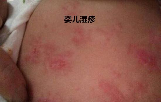 湿疹和热疹的区别图片