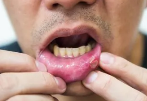 口腔溃疡10秒治愈方法