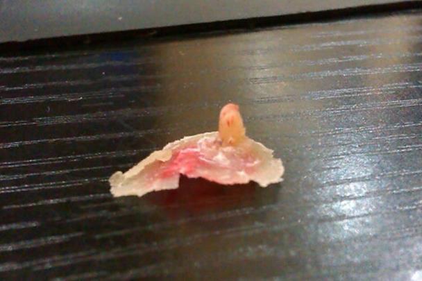 肉刺长什么样子图片