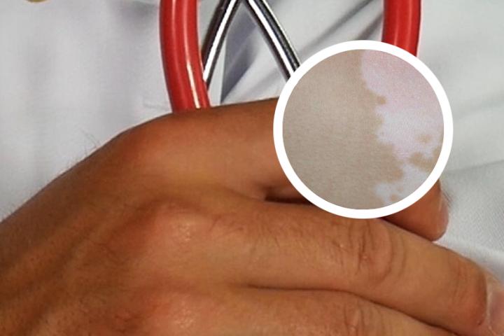 用什么土方治白斑