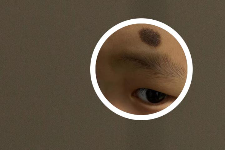 色素痣有必要切除吗