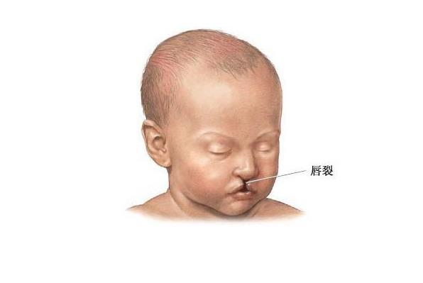 什么是唇腭裂?唇腭裂应如何治疗? 