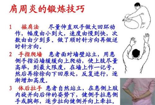 肩周炎的症状表现