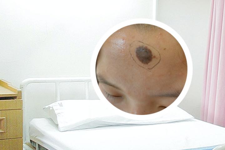 咖啡斑图片