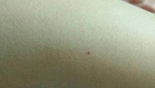 白血病初期小红点图片
