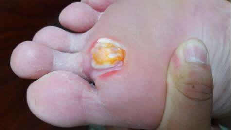 肉刺长什么样子图片