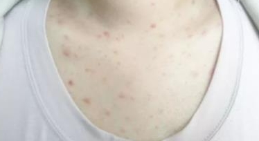 螨虫咬了是什么样子图