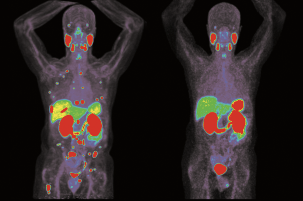 UCLA Health｜精准靶向疗法推动儿童甲状腺癌治疗新进展