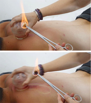 手把手教你拔罐