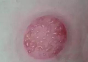 手把手教你拔罐